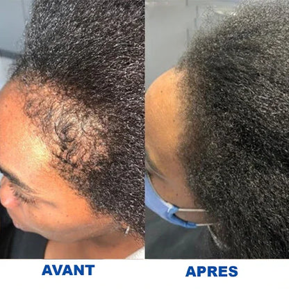 Sérum pour inverser la chute des cheveux