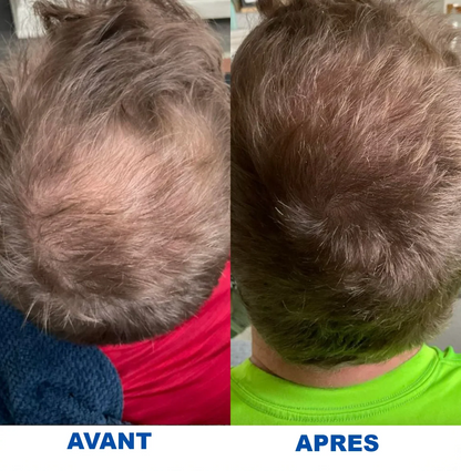 Sérum pour inverser la chute des cheveux