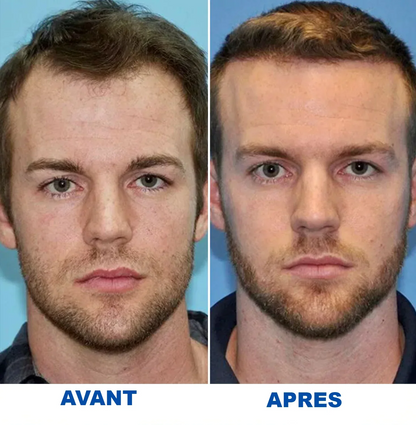 Sérum pour inverser la chute des cheveux