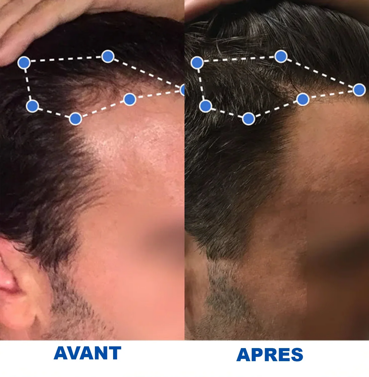 Sérum pour inverser la chute des cheveux